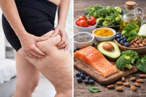 What Is Lipedema? Symptoms and Treatment Process
